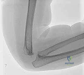 كسر اللقيمة الوحشية للعضد عند الأطفال: دليل شامل للآباء والعلاج المتخصص في صنعاء