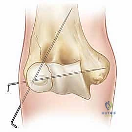 صورة توضيحية لـ كسر اللقيمة الوحشية للعضد عند الأطفال: دليل شامل للآباء والعلاج المتخصص في صنعاء