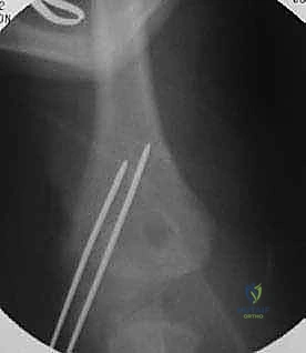 صورة توضيحية لـ كسر اللقيمة الوحشية للعضد عند الأطفال: دليل شامل للآباء والعلاج المتخصص في صنعاء