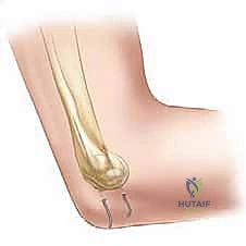 صورة طبية: كسر اللقيمة الوحشية للعضد عند الأطفال: دليل شامل للآباء والعلاج المتخصص في صنعاء