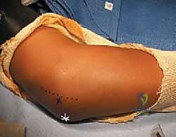 صورة طبية: كسر اللقيمة الوحشية للعضد عند الأطفال: دليل شامل للآباء والعلاج المتخصص في صنعاء