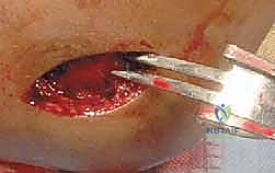 صورة طبية: كسر اللقيمة الوحشية للعضد عند الأطفال: دليل شامل للآباء والعلاج المتخصص في صنعاء