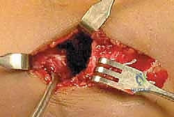 صورة طبية: كسر اللقيمة الوحشية للعضد عند الأطفال: دليل شامل للآباء والعلاج المتخصص في صنعاء