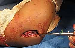 صورة توضيحية لـ كسر اللقيمة الوحشية للعضد عند الأطفال: دليل شامل للآباء والعلاج المتخصص في صنعاء