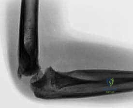 Open Reduction and Internal Fixation of Pediatric Lateral Condyle Humerus Fractures: An Intraoperative Masterclass