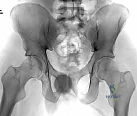 استخدام الصفائح المعدنية والمسامير في الحوض