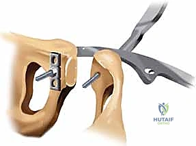 الدقة الجراحية في تثبيت العظام