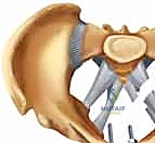 صورة طبية: تثبيت المفصل العاني المفتوح: استعادة استقرار الحوض مع الأستاذ الدكتور محمد هطيف في صنعاء