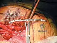 صورة توضيحية لـ تثبيت المفصل العاني المفتوح: استعادة استقرار الحوض مع الأستاذ الدكتور محمد هطيف في صنعاء