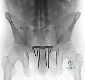 صورة توضيحية لـ تثبيت المفصل العاني المفتوح: استعادة استقرار الحوض مع الأستاذ الدكتور محمد هطيف في صنعاء