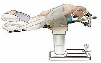 صورة توضيحية لـ تخفيف الضغط الخلفي ودمج الفقرات العنقية: دليل المريض الشامل مع الأستاذ الدكتور محمد هطيف في صنعاء