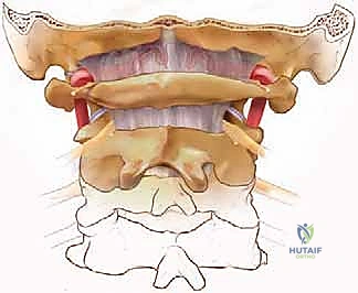 تخفيف الضغط الخلفي ودمج الفقرات العنقية: دليل المريض الشامل مع الأستاذ الدكتور محمد هطيف في صنعاء