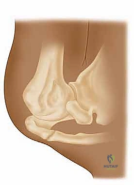 صورة طبية: مناهج جراحة الكتف وعظم العضد: دليل شامل للمرضى مع الأستاذ الدكتور محمد هطيف في صنعاء