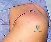 مناهج جراحة الكتف وعظم العضد: دليل شامل للمرضى مع الأستاذ الدكتور محمد هطيف في صنعاء