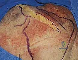 تشريح عظام ومفاصل الكتف