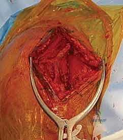 صورة طبية: مناهج جراحة الكتف وعظم العضد: دليل شامل للمرضى مع الأستاذ الدكتور محمد هطيف في صنعاء