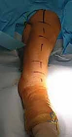 عضلات الكفة المدورة