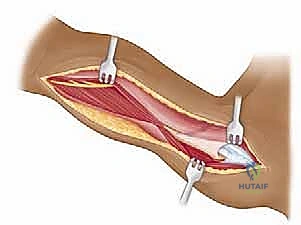 صورة طبية: مناهج جراحة الكتف وعظم العضد: دليل شامل للمرضى مع الأستاذ الدكتور محمد هطيف في صنعاء