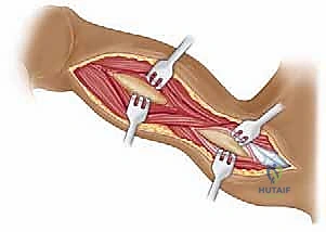 صورة طبية: مناهج جراحة الكتف وعظم العضد: دليل شامل للمرضى مع الأستاذ الدكتور محمد هطيف في صنعاء