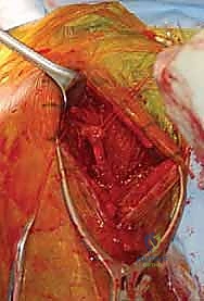 صورة طبية: مناهج جراحة الكتف وعظم العضد: دليل شامل للمرضى مع الأستاذ الدكتور محمد هطيف في صنعاء