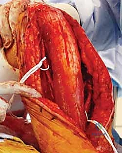 صورة طبية: مناهج جراحة الكتف وعظم العضد: دليل شامل للمرضى مع الأستاذ الدكتور محمد هطيف في صنعاء