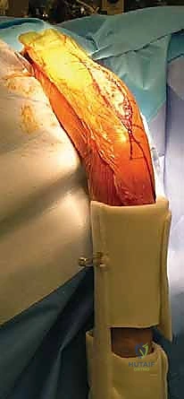 صورة توضيحية لـ مناهج جراحة الكتف وعظم العضد: دليل شامل للمرضى مع الأستاذ الدكتور محمد هطيف في صنعاء