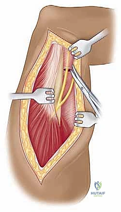 صورة توضيحية لـ مناهج جراحة الكتف وعظم العضد: دليل شامل للمرضى مع الأستاذ الدكتور محمد هطيف في صنعاء
