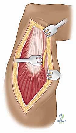 خشونة مفصل الكتف