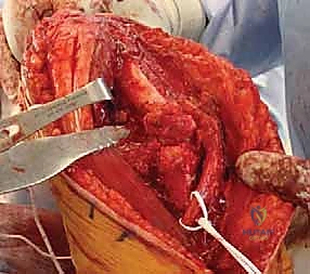 صورة طبية: مناهج جراحة الكتف وعظم العضد: دليل شامل للمرضى مع الأستاذ الدكتور محمد هطيف في صنعاء