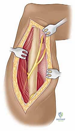 صورة توضيحية لـ مناهج جراحة الكتف وعظم العضد: دليل شامل للمرضى مع الأستاذ الدكتور محمد هطيف في صنعاء