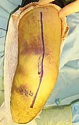 صورة طبية: مناهج جراحة الكتف وعظم العضد: دليل شامل للمرضى مع الأستاذ الدكتور محمد هطيف في صنعاء