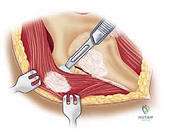 صورة طبية: مناهج جراحة الكتف وعظم العضد: دليل شامل للمرضى مع الأستاذ الدكتور محمد هطيف في صنعاء