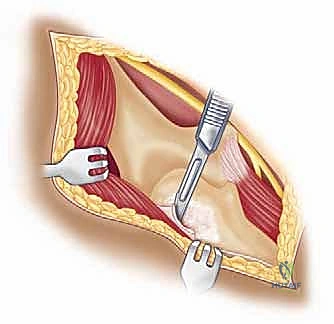 النهج الخلفي للكتف