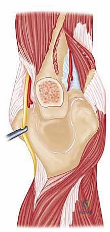 صورة توضيحية لـ مناهج جراحة الكتف وعظم العضد: دليل شامل للمرضى مع الأستاذ الدكتور محمد هطيف في صنعاء