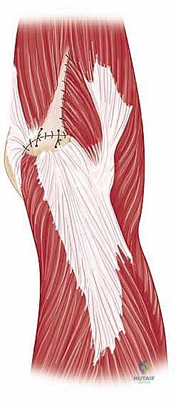 صورة طبية: مناهج جراحة الكتف وعظم العضد: دليل شامل للمرضى مع الأستاذ الدكتور محمد هطيف في صنعاء