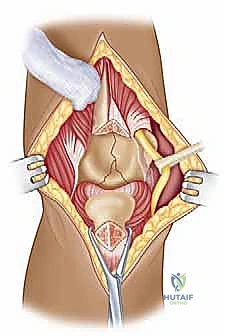 صورة طبية: مناهج جراحة الكتف وعظم العضد: دليل شامل للمرضى مع الأستاذ الدكتور محمد هطيف في صنعاء