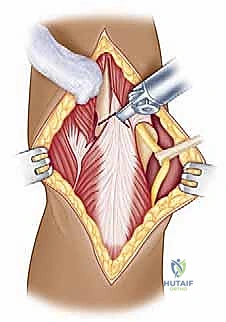 تمزق الكفة المدورة