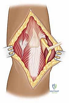 صورة طبية: مناهج جراحة الكتف وعظم العضد: دليل شامل للمرضى مع الأستاذ الدكتور محمد هطيف في صنعاء