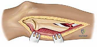 خلع الكتف وعدم الاستقرار
