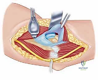 صورة طبية: مناهج جراحة الكتف وعظم العضد: دليل شامل للمرضى مع الأستاذ الدكتور محمد هطيف في صنعاء