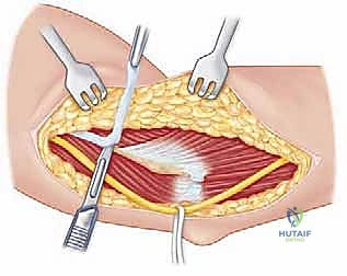 صورة توضيحية لـ مناهج جراحة الكتف وعظم العضد: دليل شامل للمرضى مع الأستاذ الدكتور محمد هطيف في صنعاء