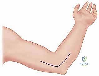 النهج الأمامي الجانبي