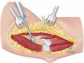 كسور عظم العضد والكتف