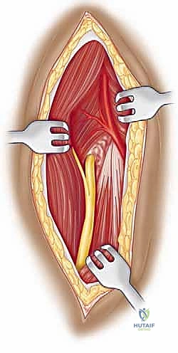 صورة توضيحية لـ مناهج جراحة الكتف وعظم العضد: دليل شامل للمرضى مع الأستاذ الدكتور محمد هطيف في صنعاء