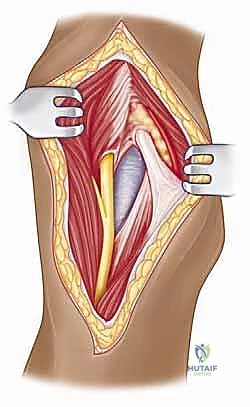 صورة طبية: مناهج جراحة الكتف وعظم العضد: دليل شامل للمرضى مع الأستاذ الدكتور محمد هطيف في صنعاء