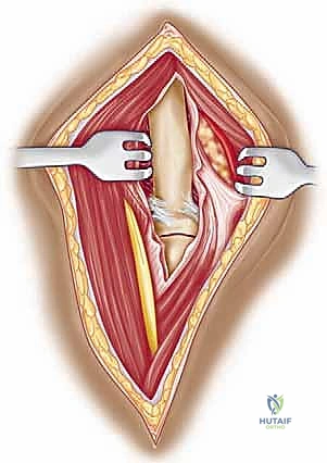 جراحة جسم عظم العضد