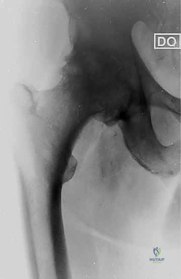 الغرسات غير الإسمنتية والتصميم المسامي