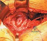 تآكل مفصل الورك والنخر العظمي