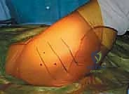 صورة توضيحية لـ استبدال مفصل الورك الكلي غير الإسمنتي: دليل شامل للمرضى مع الأستاذ الدكتور محمد هطيف في صنعاء