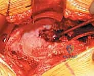 أسباب تلف مفصل الورك